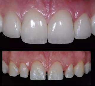 Протезирование зубов